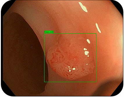 O VisionAI a destacar um pólipo detetado com uma pontuação de confiança numa imagem de endoscopia em tempo real